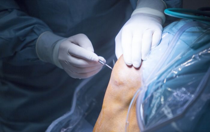 Arthroscopy